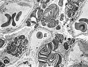 M,27y. | sea-blue histiocyte syndrome M,27y. | sea-blue histiocyte syndrome